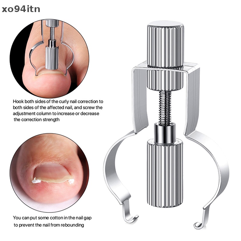 Dụng Cụ Định Hình Móng Chân Mọc Ngược Tiện Dụng