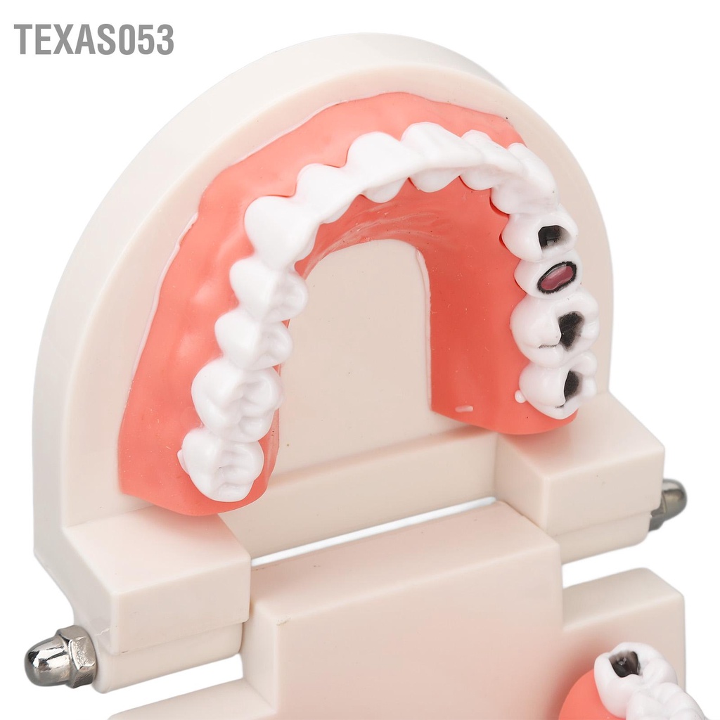 Texas053 Bệnh Nha Khoa Sâu Răng Mô Hình Nhựa Phỏng Giảng Dạy Chống Đỡ Cho Nhân Học Sinh Giáo Dục