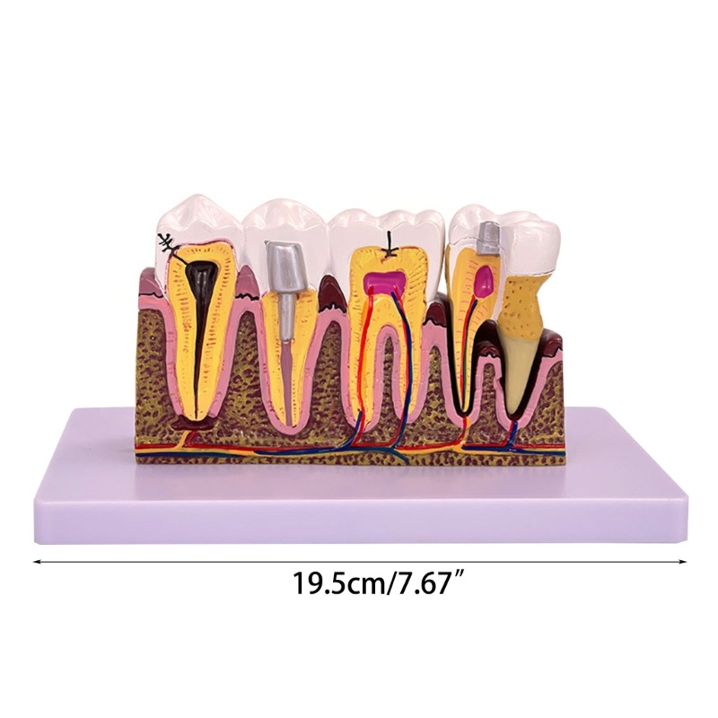 Mô Hình Hàm Răng Giảng Dạy Trong 4 Lần Chuyên Dụng Cho Nha Khoa