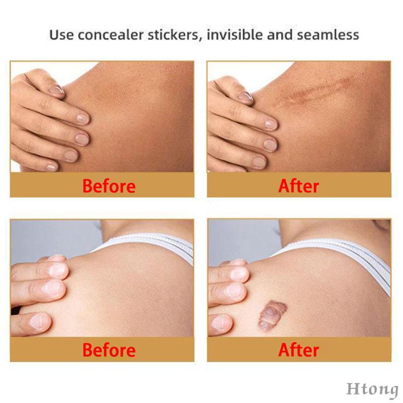 Cuộn Băng Keo Silicone Làm Mờ Sẹo