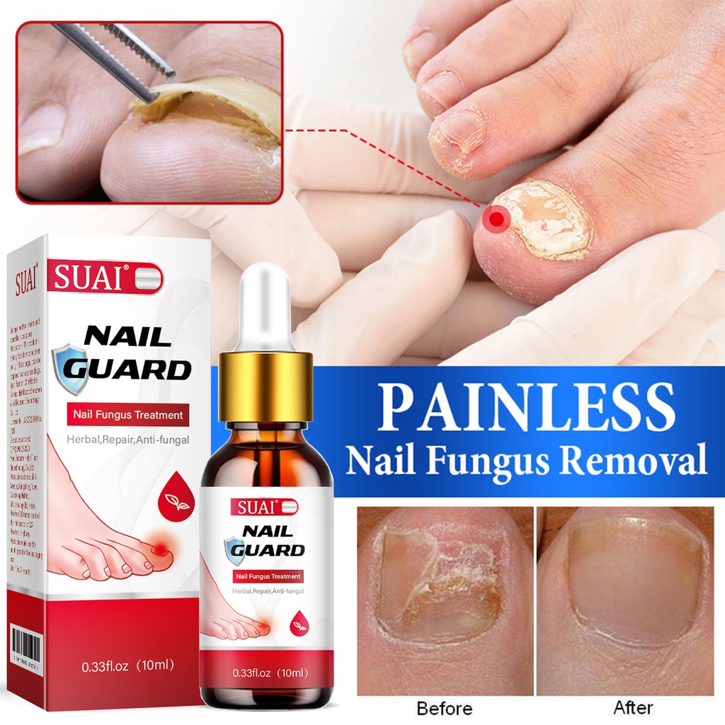 10ml Móng Tay Điều Hỗ trợ giảm nấm Serum Chống Nhiễm Trùng Paronychia Onychomycosis Loại Bỏ Ngón Chân Nấm Bàn Tay Sửa Chữa Gel Chăm Sóc Serum
