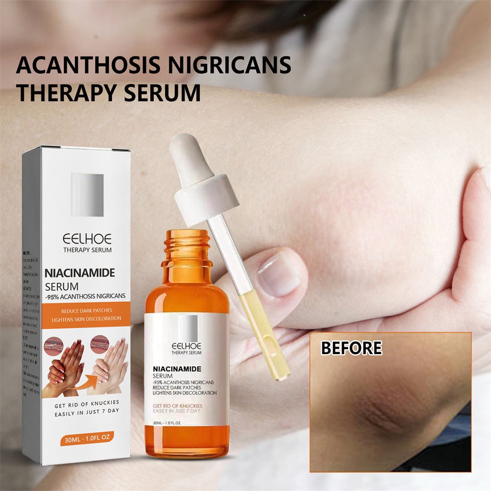 Serum tinh chất làm trắng da EELHOE Acanthosis Nigricans xóa mờ vết thâm khử đen melanin đa năng hiệu quả