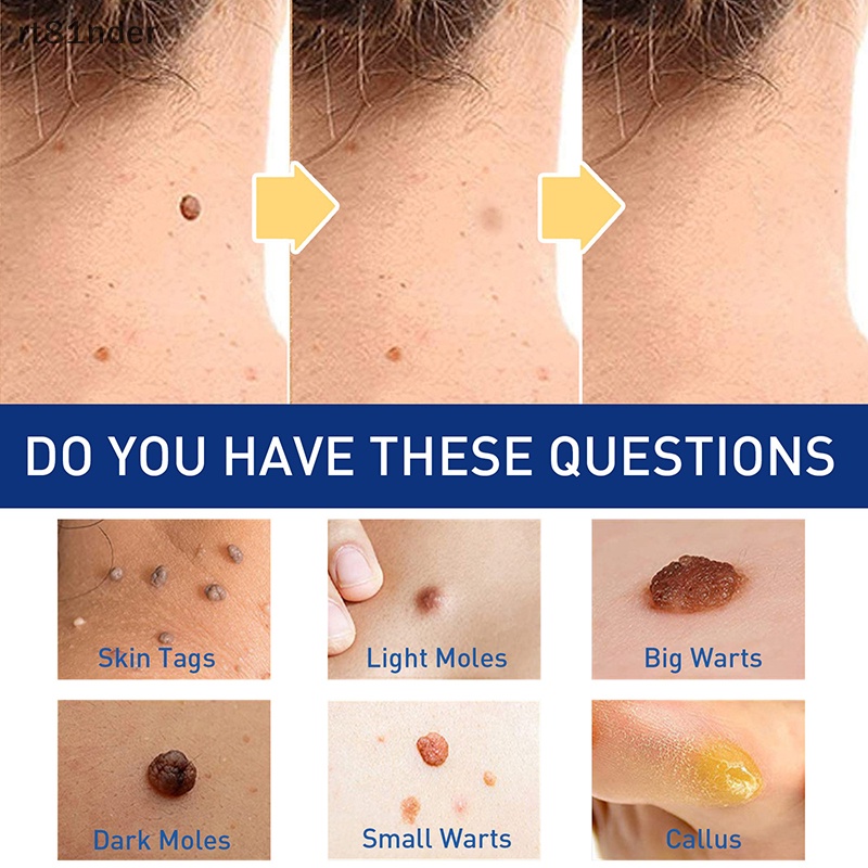 Rt 1 Dụng Cụ Kẹp Nhỏ Bằng Đồng Loại Bỏ Mụn Thịt / Hình Xăm