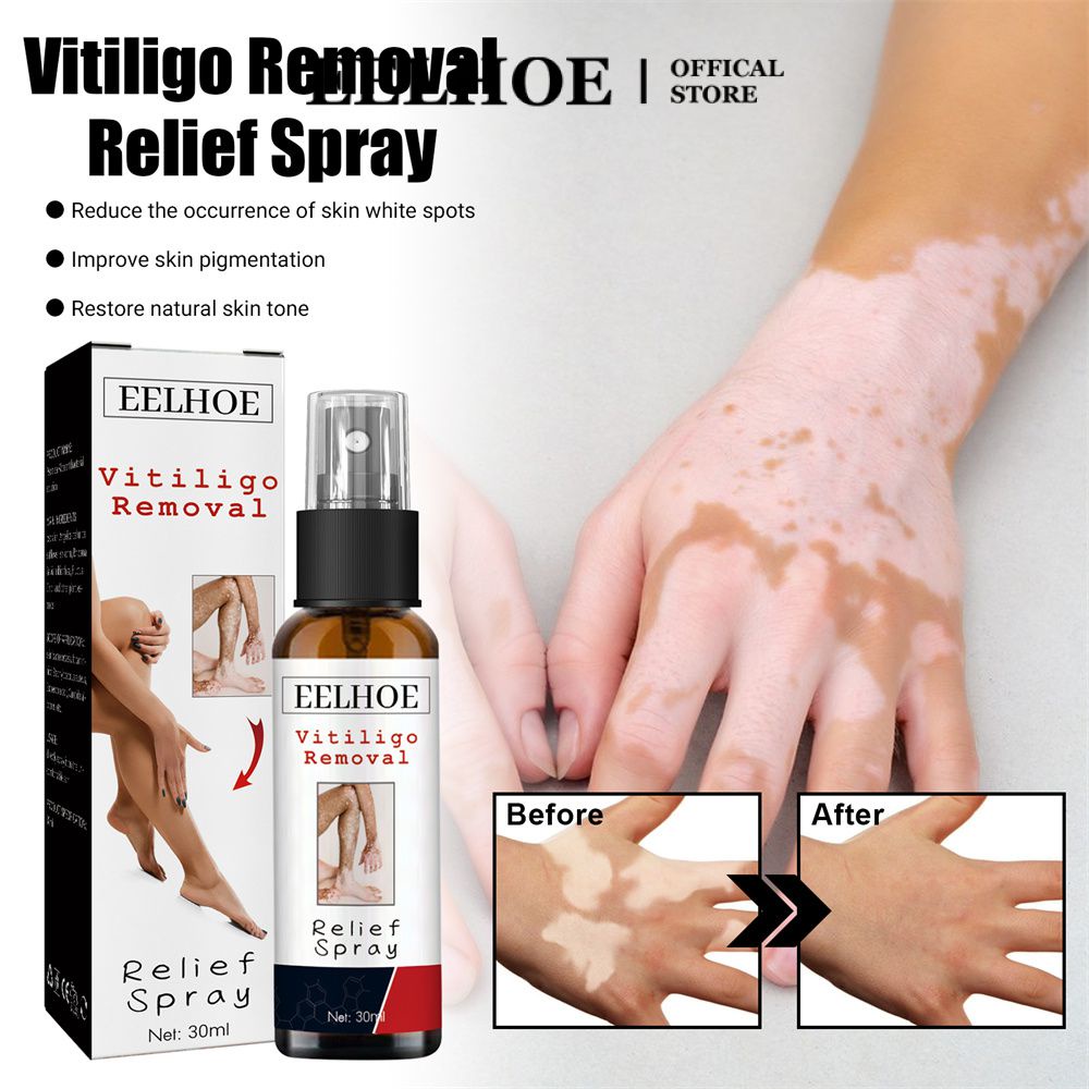 Xịt Hỗ Trợ Giảm Mụn EELHOE Vitiligo Chăm Sóc Da 30ml