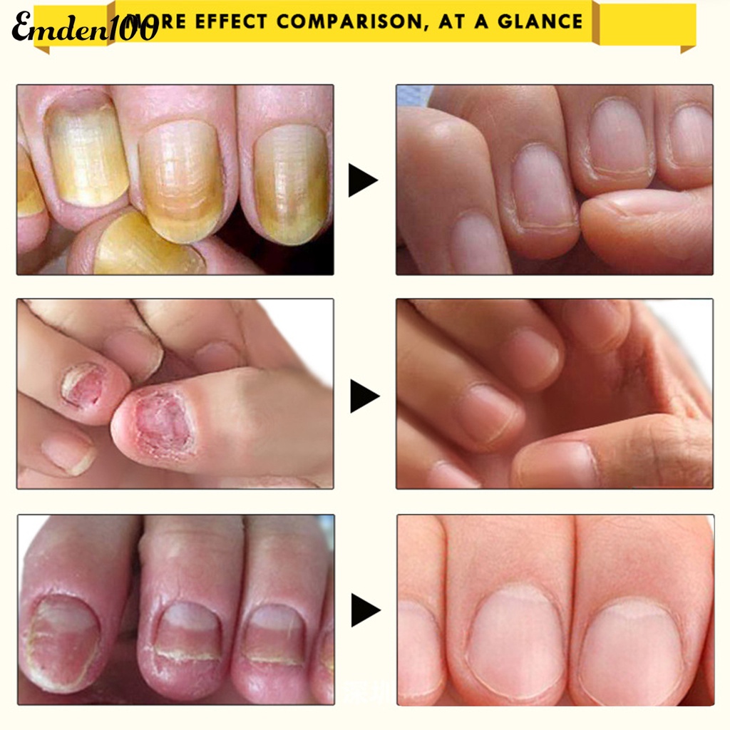 Dung Dịch Kháng Khuẩn 10ml Dễ Sử Dụng Cho Chăm Sóc Móng Tại Nhà