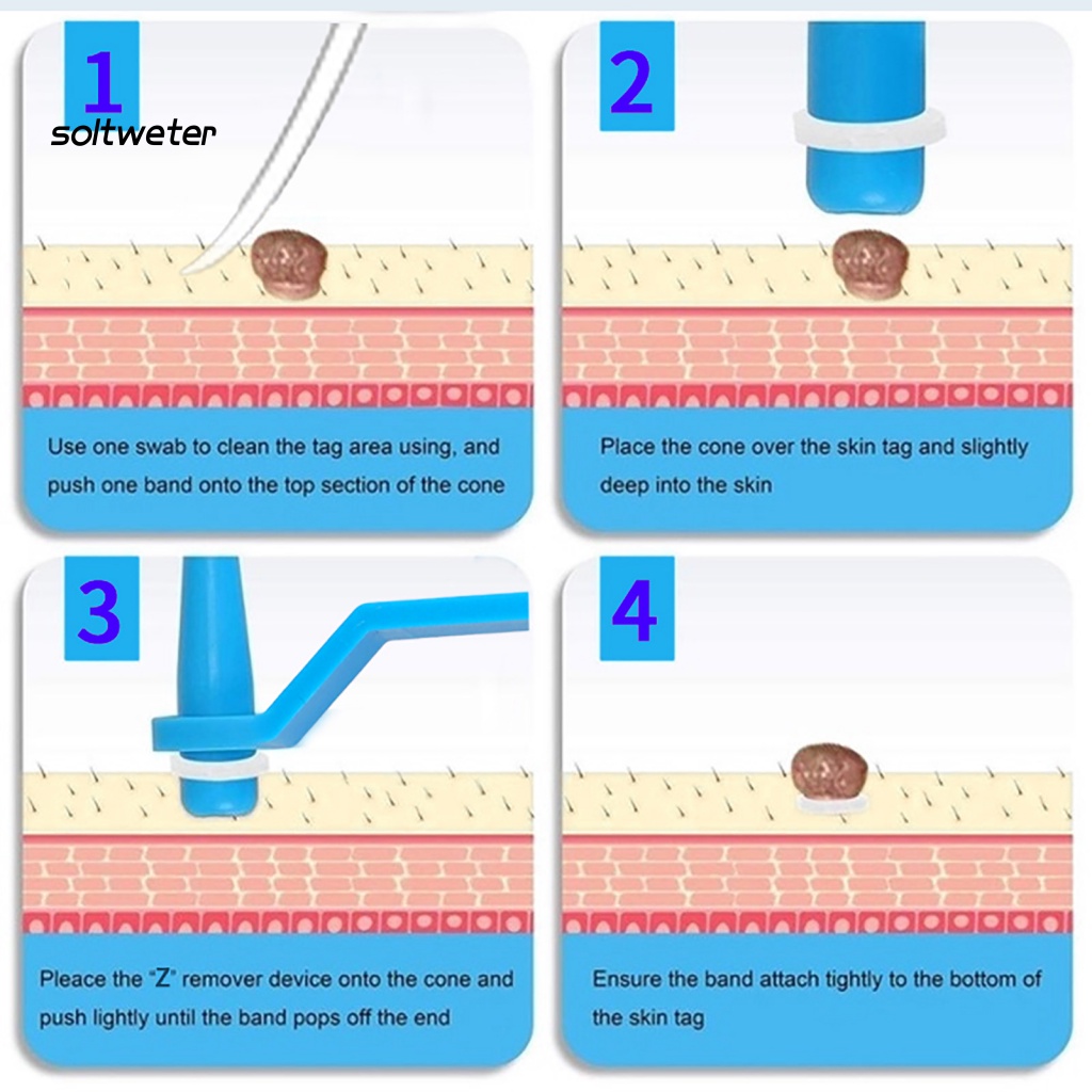 Bộ 10 / 20 / 30 / 50 Dụng Cụ Làm Sạch Mụn Cóc Bằng ABS Tiện Dụng