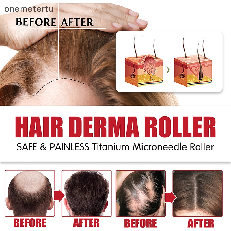 Con Lăn Massage Kích Thích Mọc Tóc Và Râu Chống Rụng Tóc Hiệu Quả