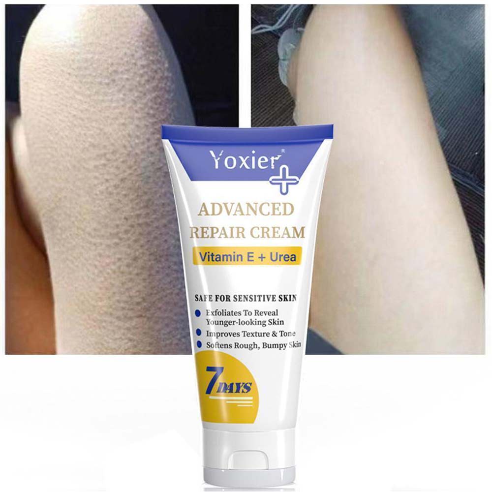 Yoxier Advanced Moisturizing Repair Cream deeply moisturizes the skin and treats itching keratosis