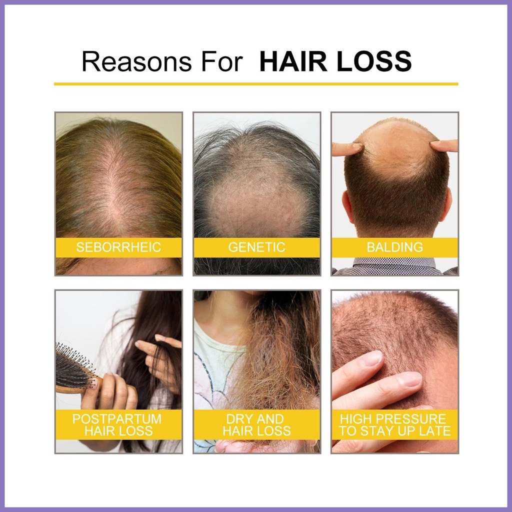 Tinh Chất Kích Thích Mọc Tóc 30ml An Toàn Cho Tóc Dày Hơn Và Rụng Tóc nota2vn