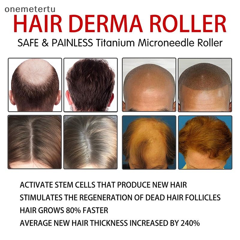 Con Lăn Massage Kích Thích Mọc Tóc Và Râu Chống Rụng Tóc Hiệu Quả