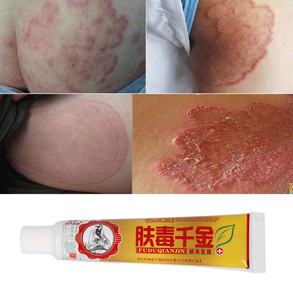 Kem Thảo Dược Trung Hoa Truyền Thống Kháng Khuẩn Chăm Sóc Da 15g