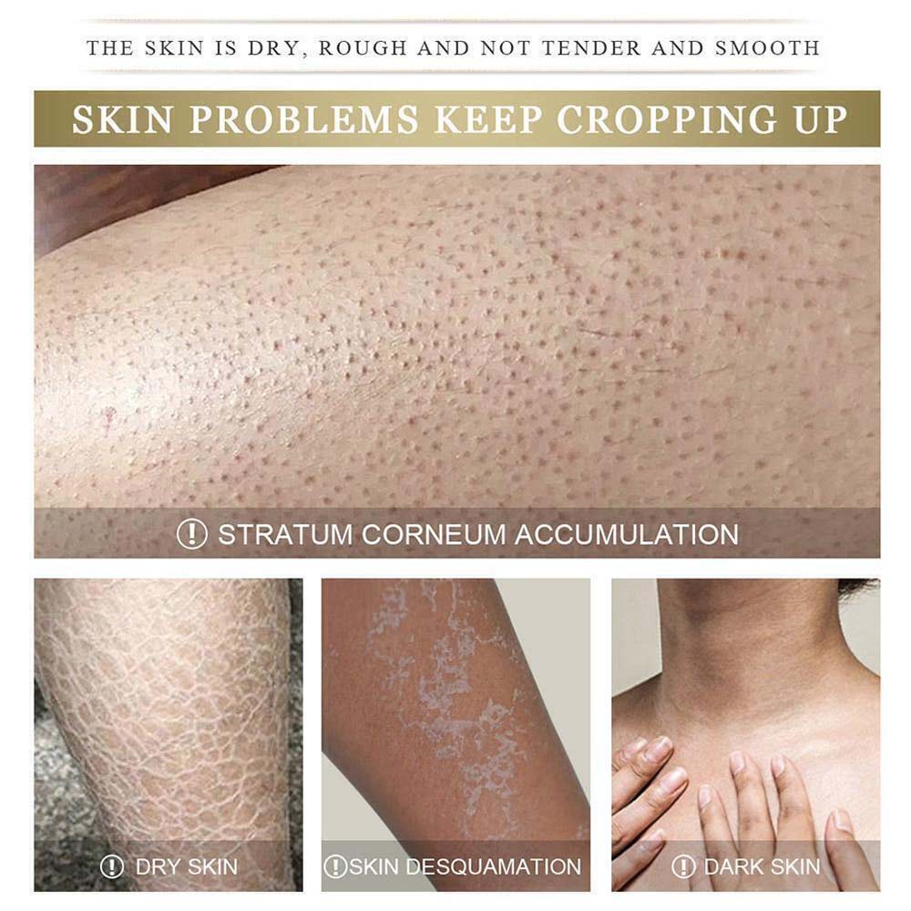 Yoxier Advanced Moisturizing Repair Cream deeply moisturizes the skin and treats itching keratosis