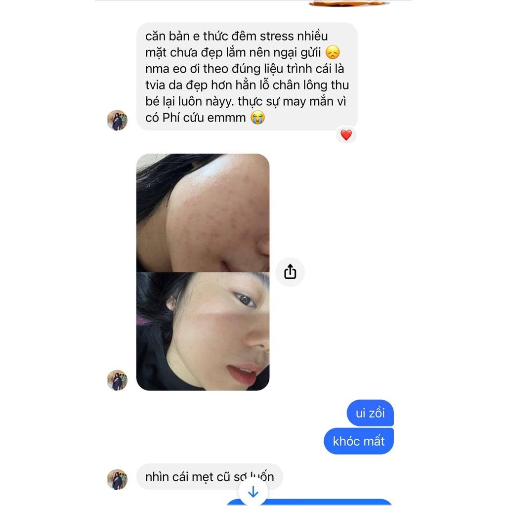 Tinh chất Martiderm Acniover Serum giảm mụn & kiểm soát nhờn 30ml  - Mika Beau&Skin