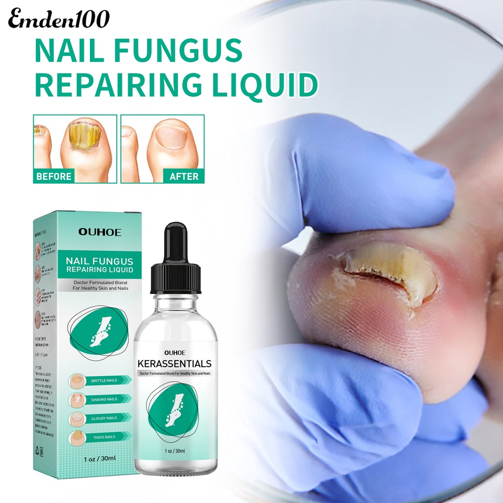 Tinh Chất Onychomycosis 30ml Hỗ Trợ Phục Hồi Móng Nhanh Chóng Và Hiệu Quả