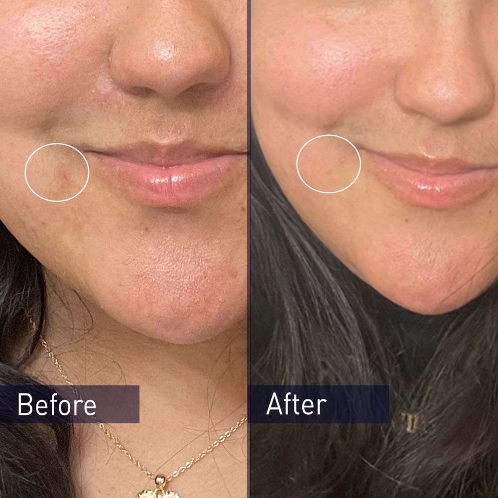 PanOxyl Facial Cleanser Facial Lotion prevents the formation of new acne, suitable for acne and oily skin  156g