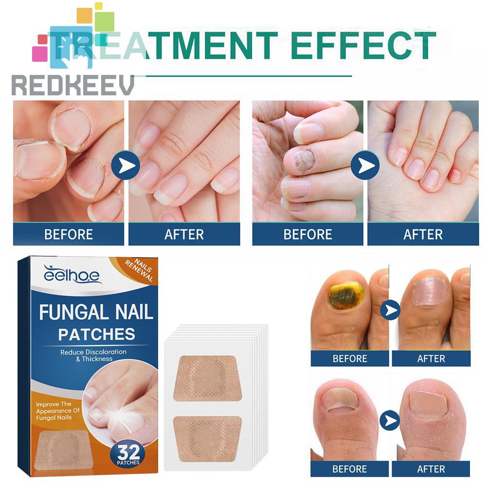 Bộ 32 Miếng Dán Điều Chỉnh Móng Tay Co Giãn Thoáng Khí Dễ Sử Dụng