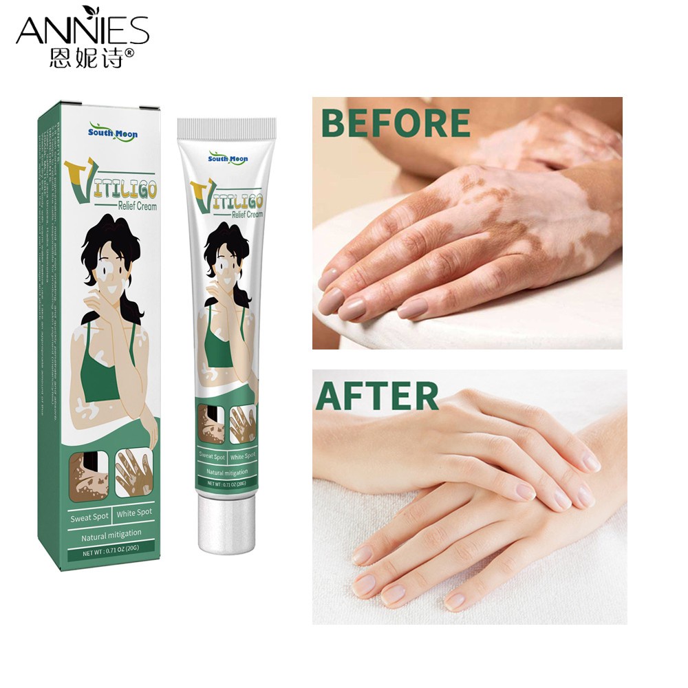 Kem cải thiện tình trạng bạch biến ANNIES dưỡng ẩm phục hồi da làm mờ vết thâm chăm sóc cơ thể 20g