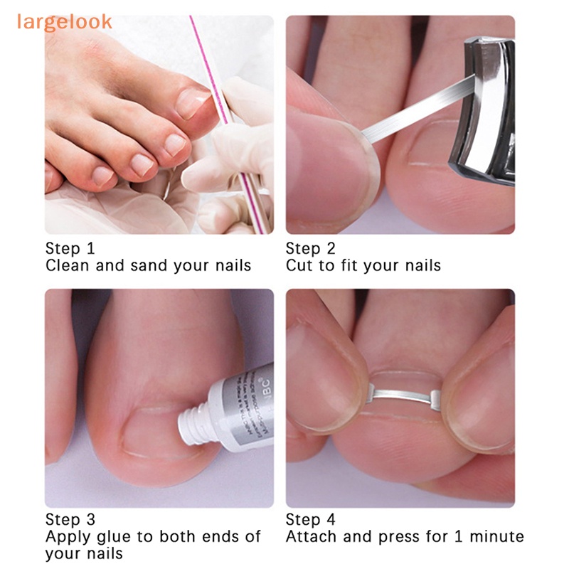 Miếng Dán Chỉnh Sửa Móng Chân Mọc Ngược Tiện Dụng