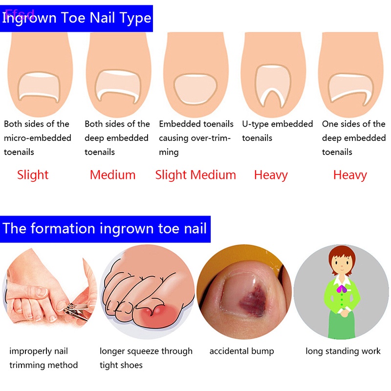 Bộ 6 Dụng Cụ Chỉnh Sửa Móng Chân Mọc Ngược Tiện Dụng