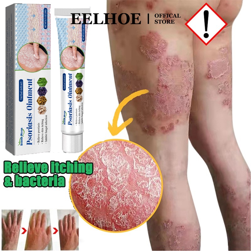 Kem giảm ngứa EELHOE thảo dược chống bệnh vẩy nến/ chàm/ nấm cho bàn tay/ bàn chân/ đùi/ các vấn đề về da 20g