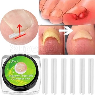 1 hộp dụng cụ chỉnh sửa móng chân mọc ngược / miếng dán móng chân mọc ngược / chỉnh sửa móng chân
