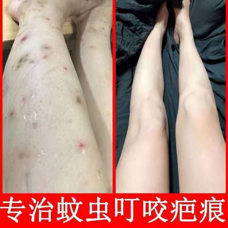 Tik Tok Cùng Phong Cách#Kem Thảo Dược Trị Sẹo Mụn Đầu Đen 6.10 ly