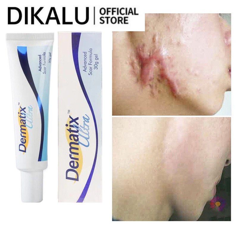 Gel xóa sẹo DIKALU Dermatix công thức loại bỏ mụn/ phục hồi da/ loại bỏ rạn da/ sẹo lồi 15g chính hãng Mỹ