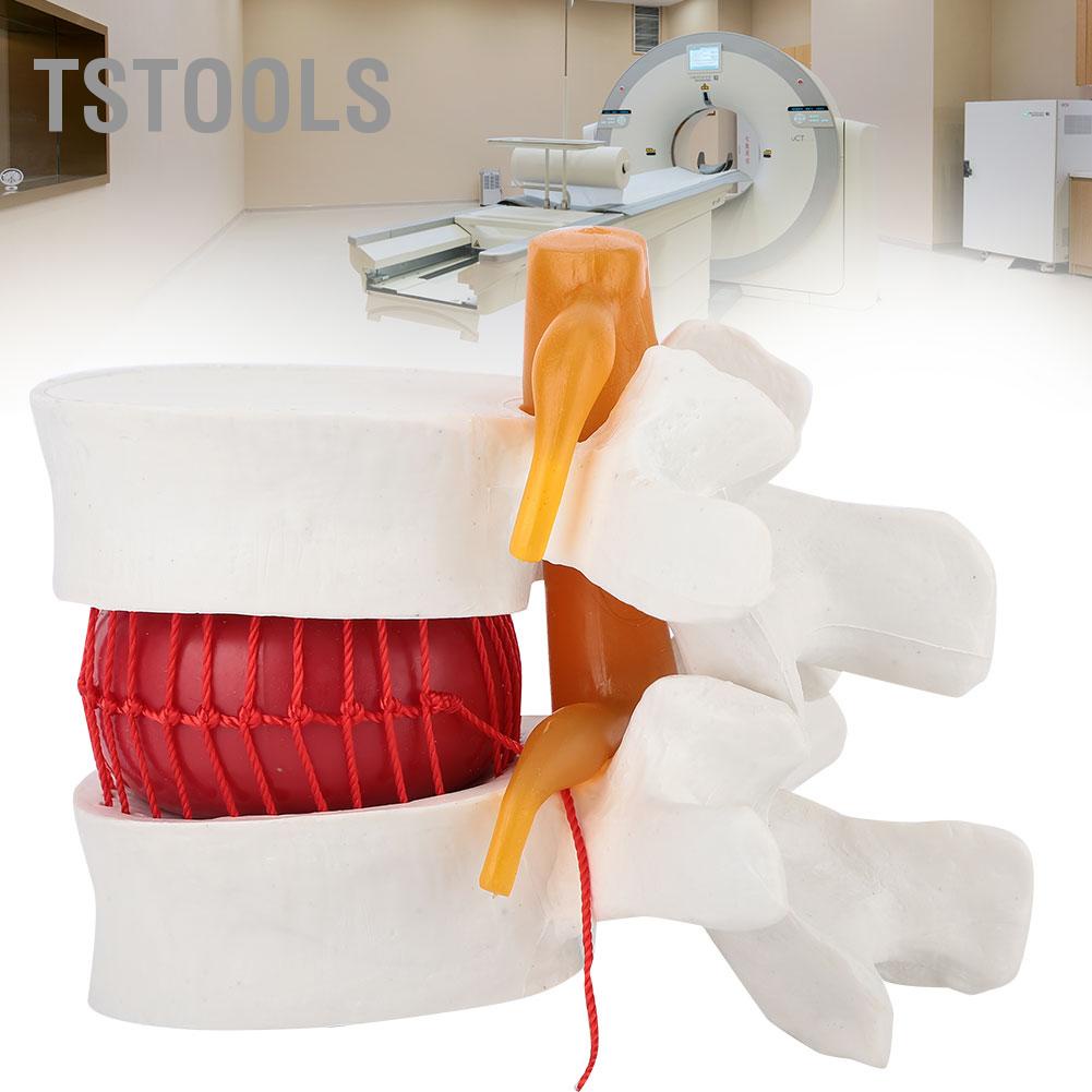 TSTOOLS 1:1.5 Mô hình trình diễn y tế của mô thoát vị đĩa đệm cột sống thắt lưng ở người