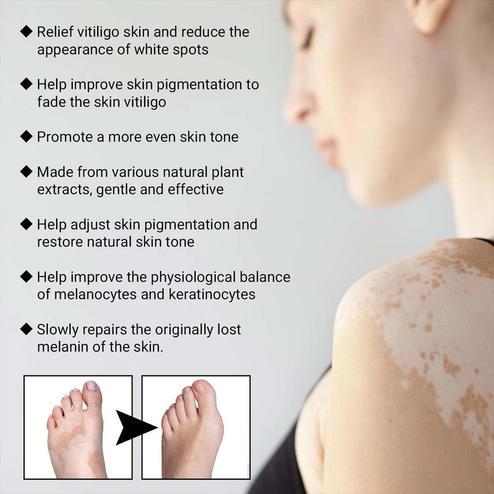 Best Vitiligo Removal Relief Spray Vitiligo Skin Repair Spray for Skin Care New