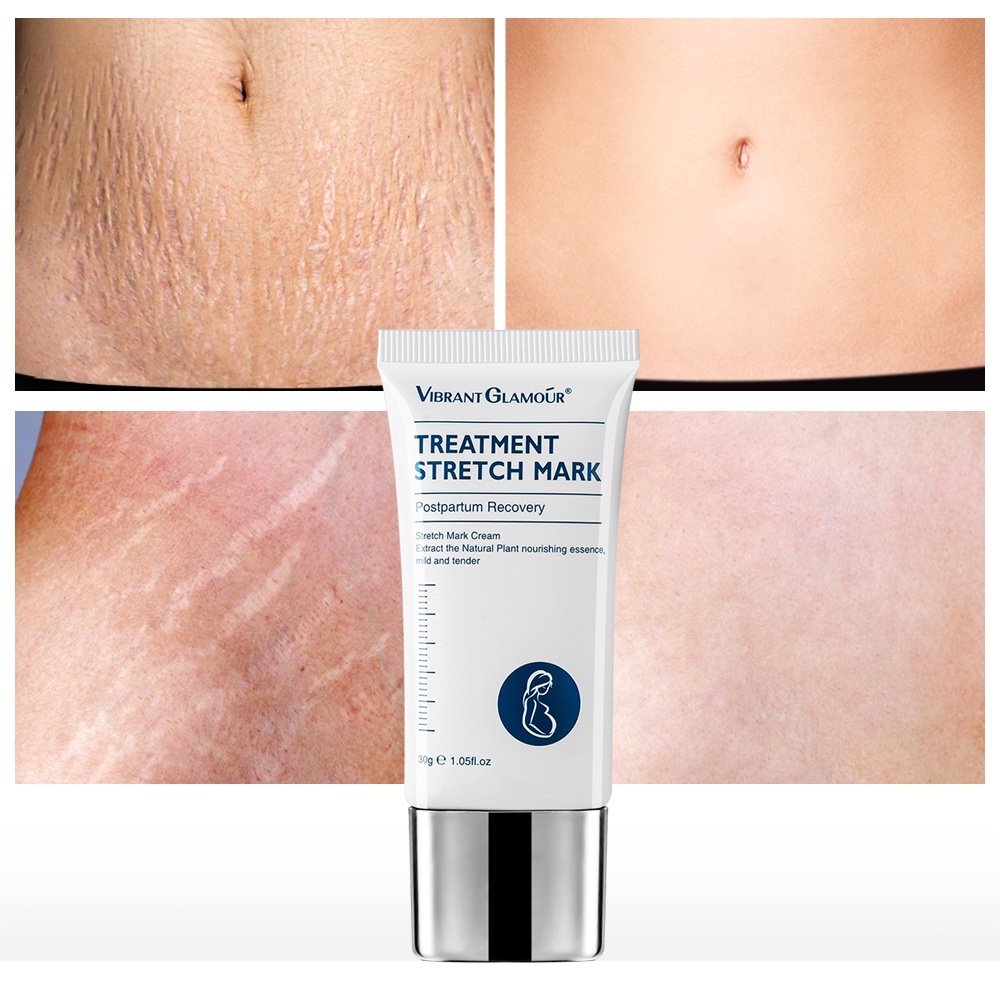 Kem hỗ trợ rạn da sau sinh, chống lão hóa VIBRANT GLAMOUR Treatment Stretch Mark 30g