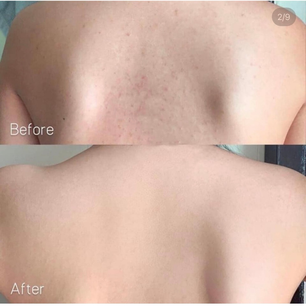 Dưỡng Thể Giảm Mụn Lưng, Giảm Viêm Nang Lông Paula's Choice Body Treatment 2% BHA