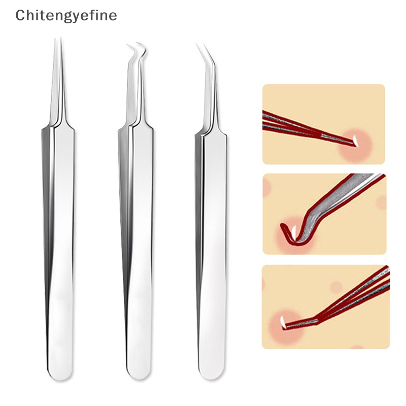 Nhíp Lấy Nhân Mụn Đầu Đen Chăm Sóc Da Mặt Mịn Màng