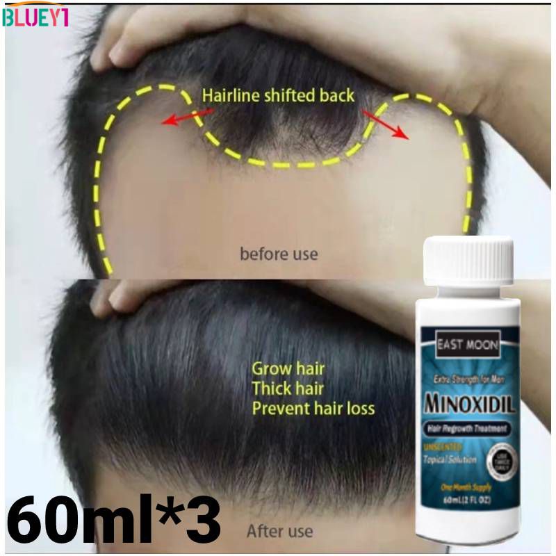 3 Chai Chính Hãng Minoxidil 5% Với Ống Nhỏ Giọt Miễn Phí (60Ml Mỗi Chai) Thuốc Mọc Tóc Thuốc Mọc Râu bluey1