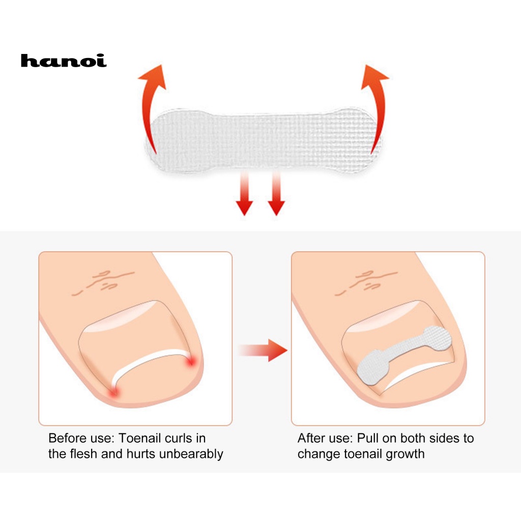 Hộp 10 Miếng Dán Chỉnh Sửa Móng Chân Nhanh Chóng Tiện Lợi