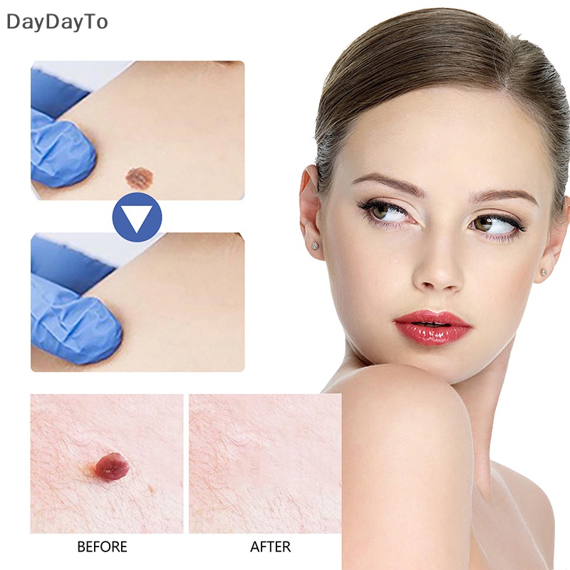 1 Dụng Cụ Kẹp Nhỏ Bằng Đồng Loại Bỏ Mụn Cóc Hình Xăm