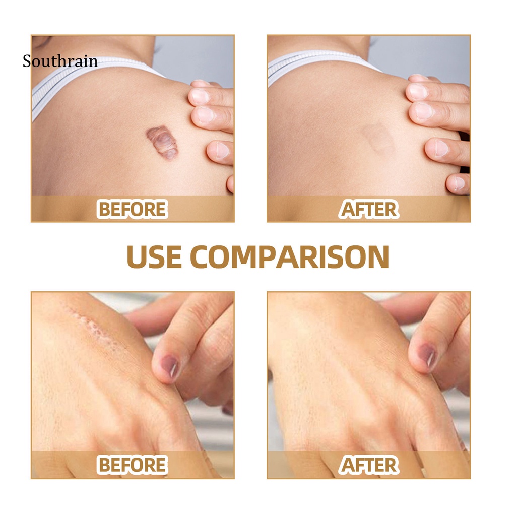 Hộp 60 Miếng Dán Sẹo Mụn Bằng Vải Không Dệt Chống Nước An Toàn Cho Nữ