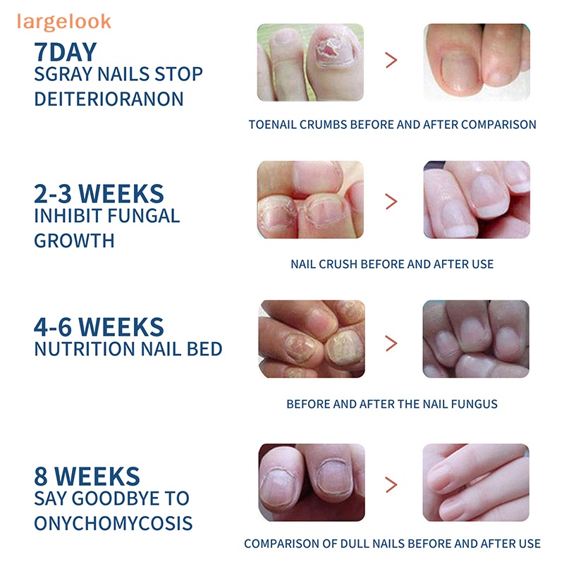 Bộ 32 Miếng Dán Chỉnh Sửa Móng Chân An Toàn