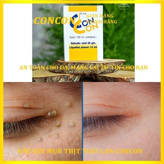 Loại bỏ mụn cóc mụn cơm Con Con Thái Lan