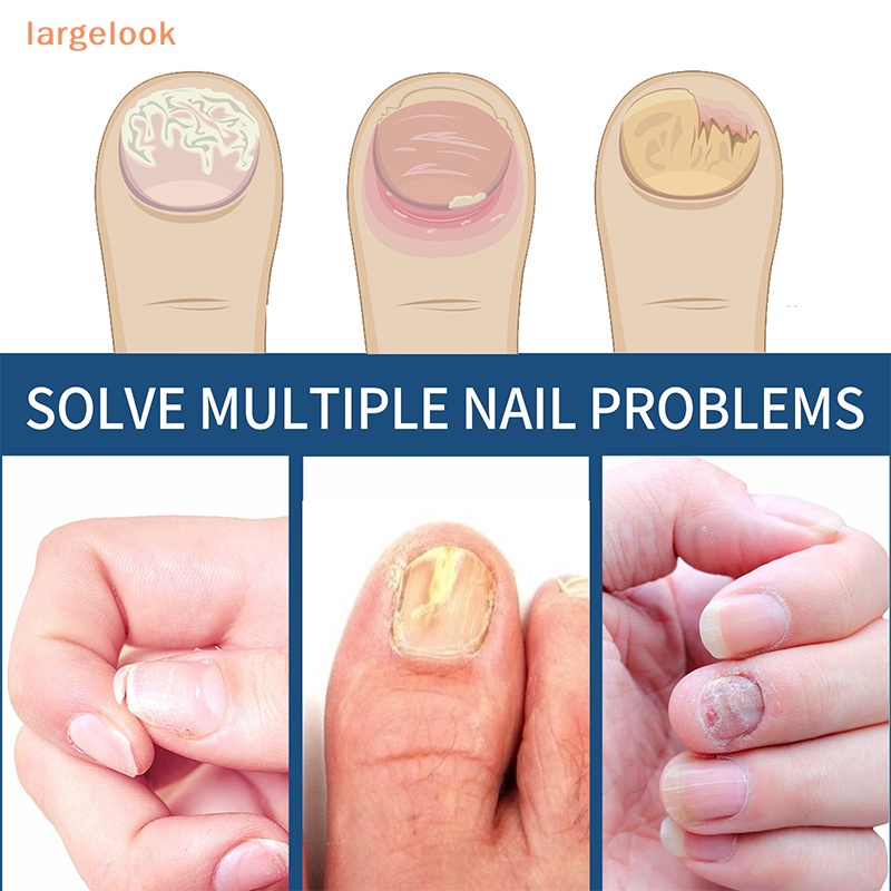 Bộ 32 Miếng Dán Chỉnh Sửa Móng Chân An Toàn