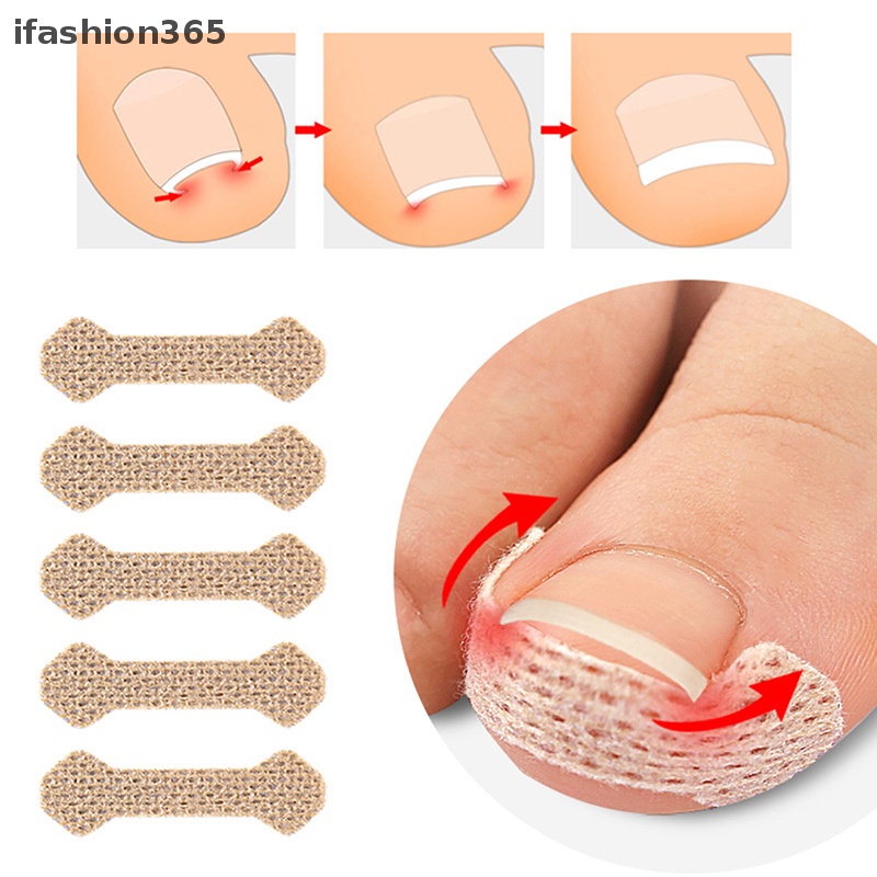 Set 4 / 10 Miếng Dán Chỉnh Hình Móng Chân Mọc Ngược ifashion365