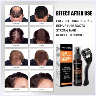 Thuốc mọc tóc chống rụng tóc xịt mọc tóc dày tinh chất mọc tóc