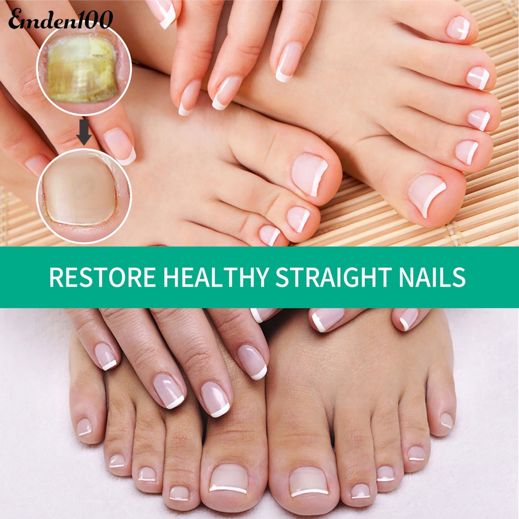 Tinh Chất Onychomycosis 30ml Hỗ Trợ Phục Hồi Móng Nhanh Chóng Và Hiệu Quả