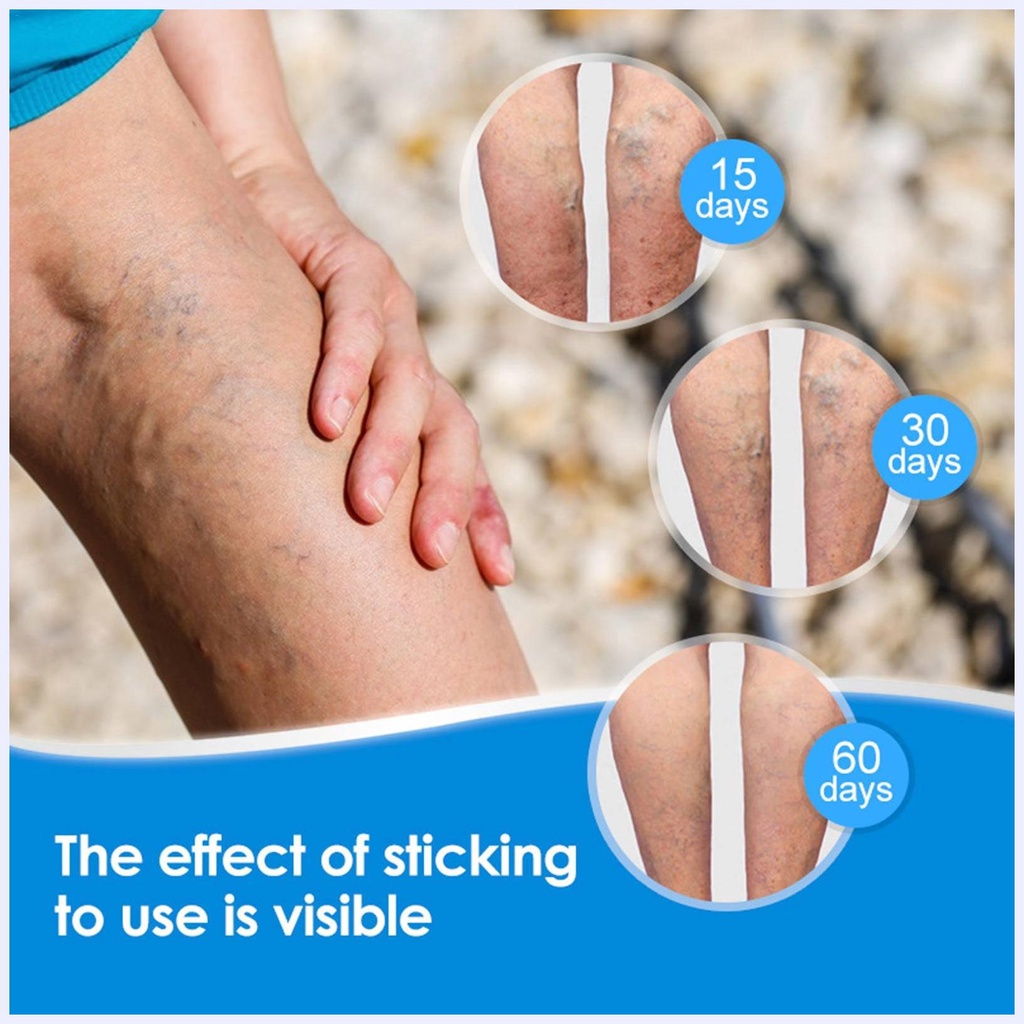 Miếng Dán Trị Giãn Tĩnh Mạch Trung Hoa Hiệu Quả