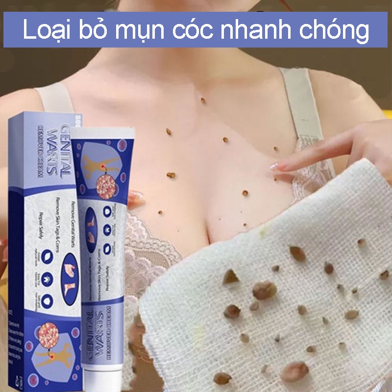 kem bôi rụng hết sạch mụn thịt thừa, mụn cóc, mụn nốt duồi và các mụn li ti quanh mắt