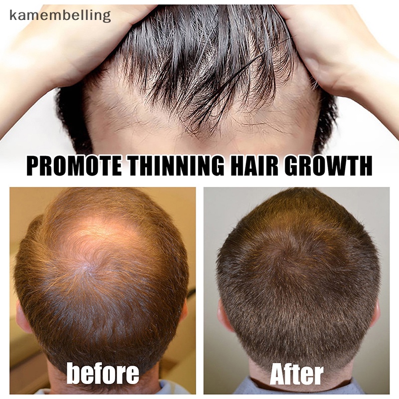 Con Lăn Mát Xa kamembelling Kích Thích Mọc Tóc Và Râu