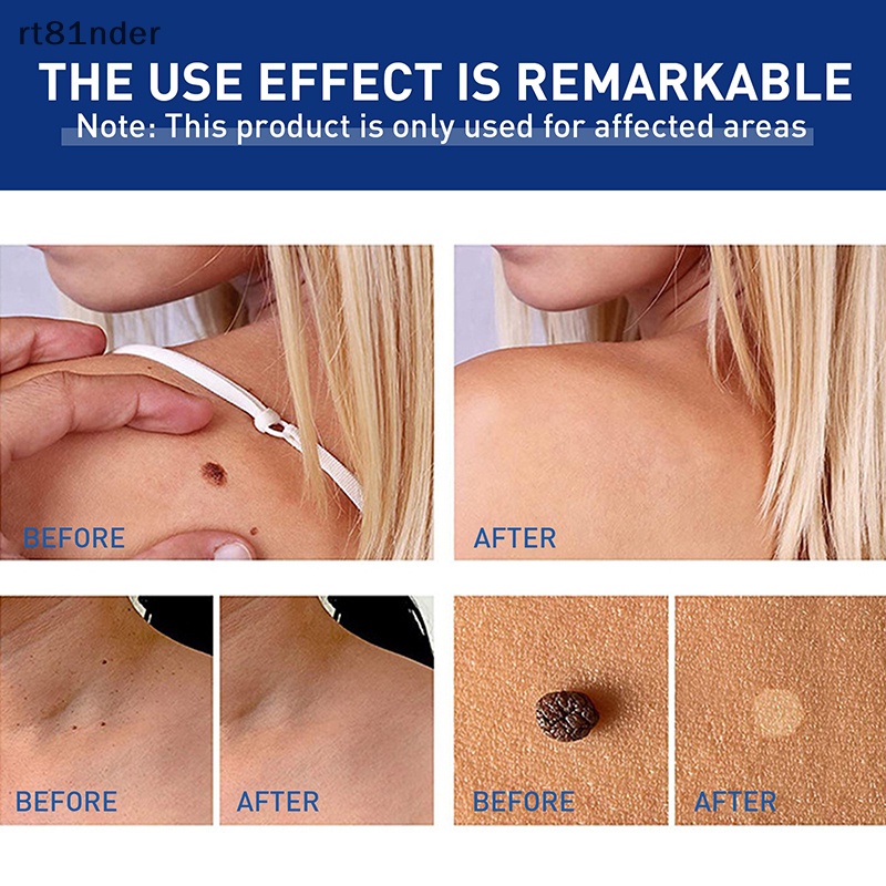 Rt 1 Dụng Cụ Kẹp Nhỏ Bằng Đồng Loại Bỏ Mụn Thịt / Hình Xăm