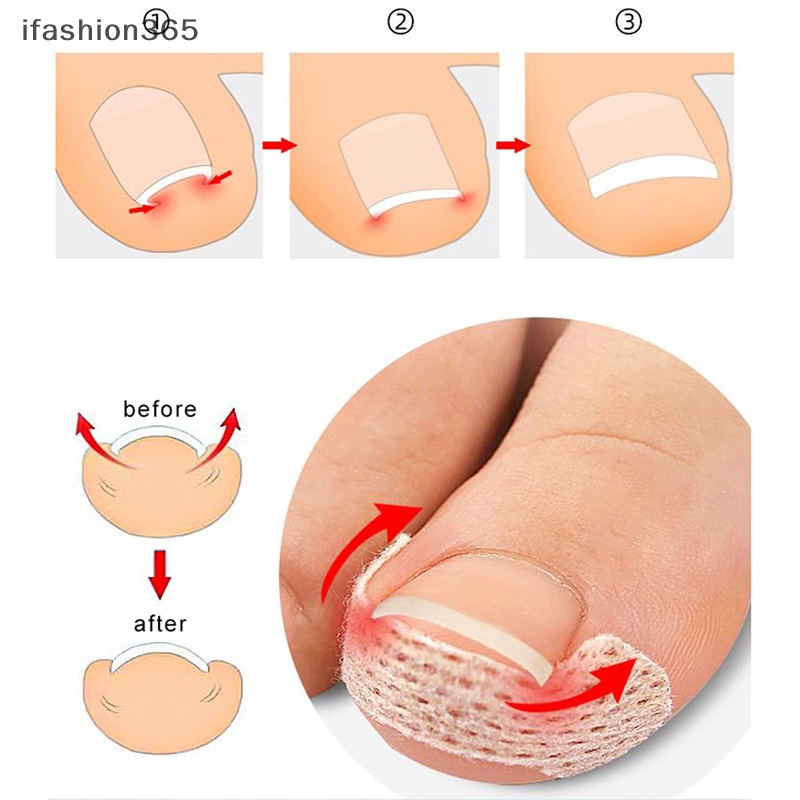 Set 4 / 10 Miếng Dán Chỉnh Hình Móng Chân Mọc Ngược ifashion365