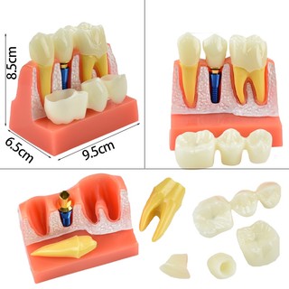 Mô hình hàm răng giả cho học sinh có thể tháo rời