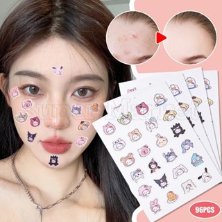  96 Miếng Dán Mụn Sanrio Kitty - Miếng Dán Điểm Mặt Hoạt Hình - Mini Removal Pimple Paster - Kem Che Khuyết Điểm Mụn Chống Thấm Nước - Đồ Chăm Sóc Da - Dụng Cụ Làm Đẹp Mụn 