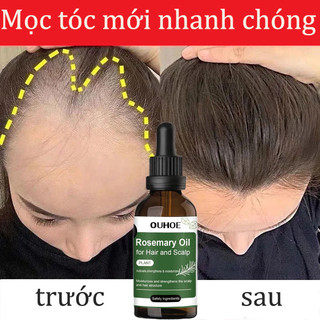 🔥 Rẻ nhất 🔥Tinh chất mọc tóc tinh dầu mọc tóc serum kích mọc tóc chăm sóc tóc chống rụng tóc,kích thích tóc mọc dà